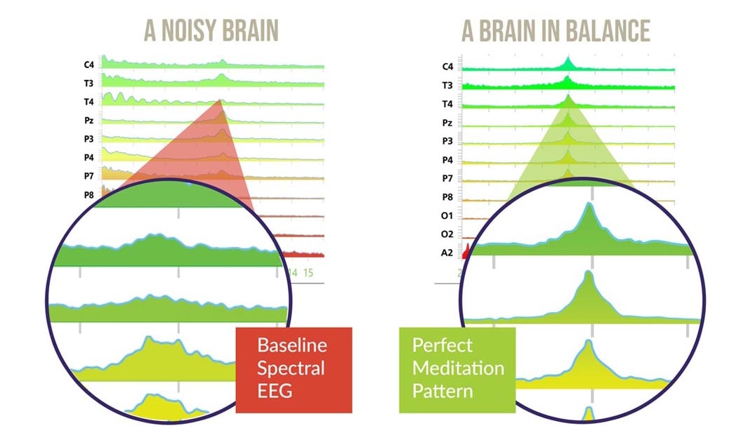 PrTMS brain scan EEG mapping technology